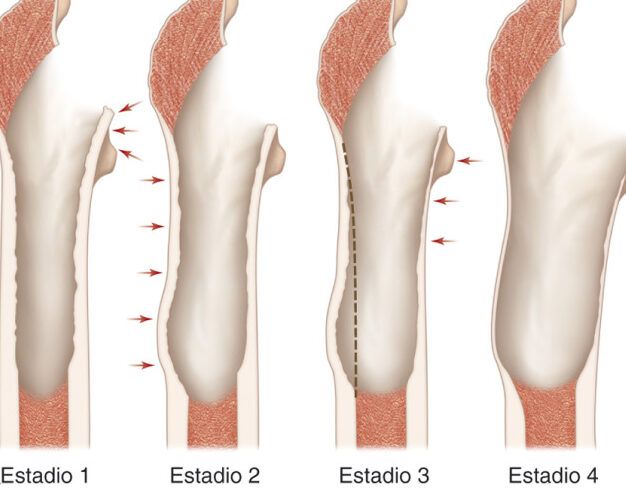 anteversion femoral que es como tratarlo y consejos