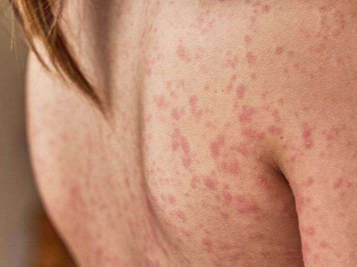 dermatitis atopica la enfermedad cutanea que mas afecta a ninos