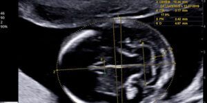 diferencias entre ecografias de 13 semanas para identificar el sexo del bebe