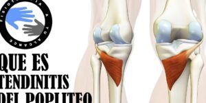 dolor en la parte posterior de la rodilla al flexionarla