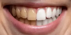 enfermedad dental que oscurece los dientes