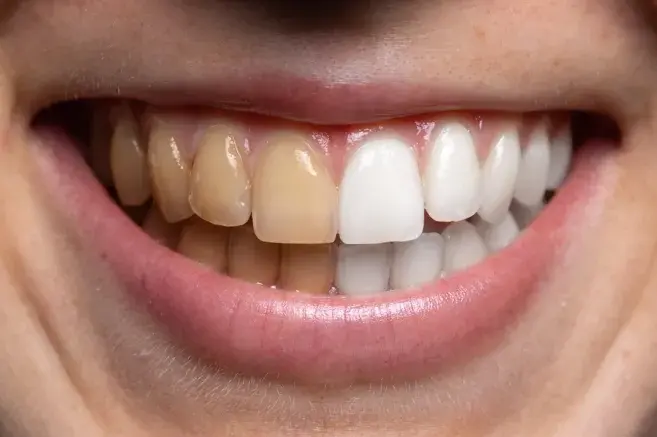 enfermedad dental que oscurece los dientes