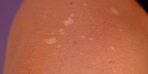 hongos cutaneos en bebes causas y tratamiento