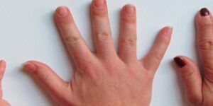 las ojeras pueden indicar la presencia de una enfermedad