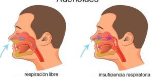 lo que hay que saber sobre la hipertrofia adenoidea