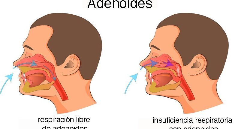 lo que hay que saber sobre la hipertrofia adenoidea