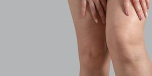 piernas hinchadas causas y soluciones