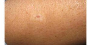 protuberancias de grasa en los labios genitales