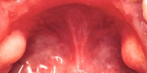 protuberancias en la punta de la lengua