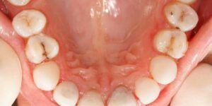 remedios para eliminar la acumulacion de pus en la garganta