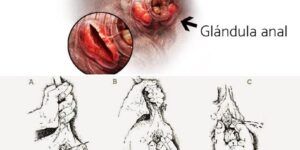 sangrado anal al realizar la higiene personal