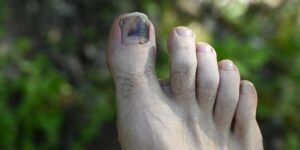 tratamiento para ampollas en los pies que han reventado