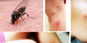 uso de crema con corticoides para aliviar picaduras de mosquitos