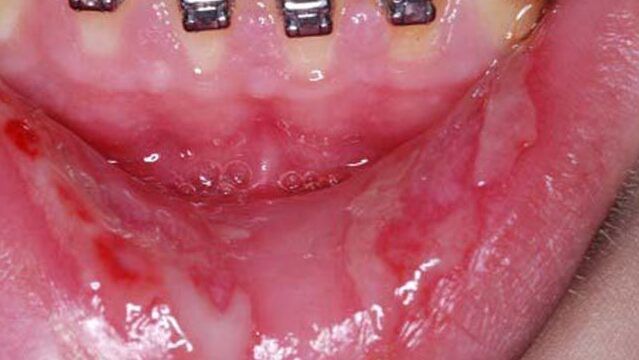 alergia al niquel en la boca