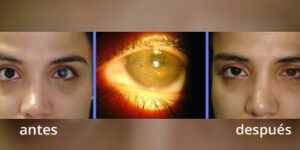 asimetria ocular y soluciones