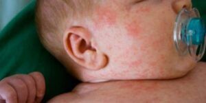 bebe con alergia a la leche