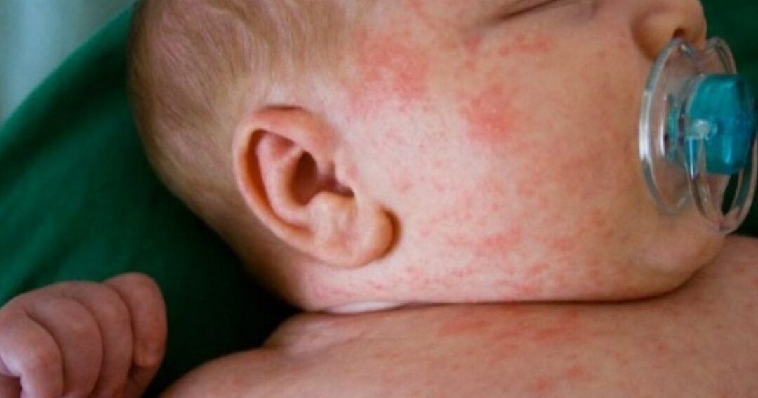 bebe con alergia a la leche