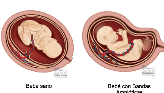 brida amniotica y feto