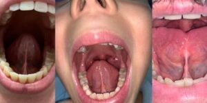 corte de frenillo de lengua