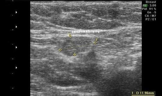 ecografia de una hernia