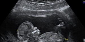 ecografia fetal en el embarazo