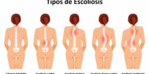 escoliosis en adolescentes opciones y beneficios