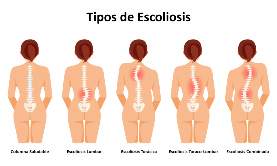 escoliosis en adolescentes opciones y beneficios