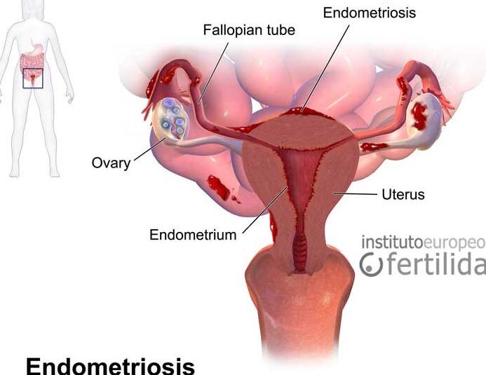fertilidad y endometriosis