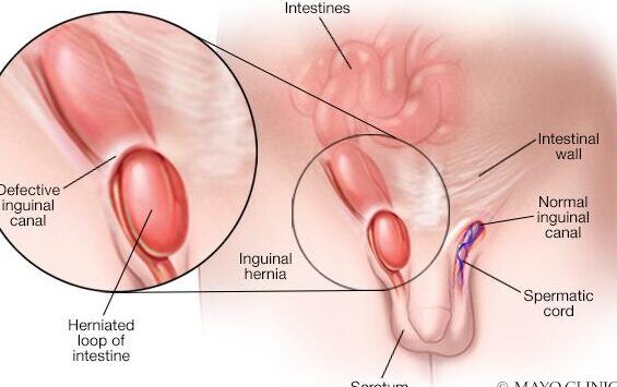 hernia inguinal