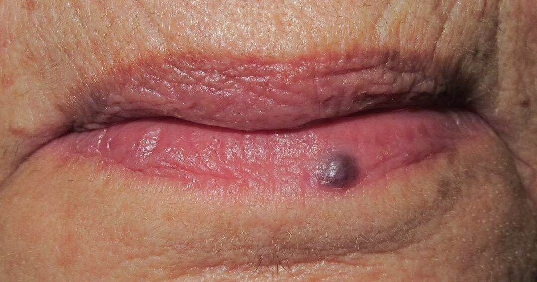 mancha violacea en labio inferior