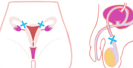 metodo anticonceptivo permanente