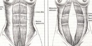 mujer embarazada con diastasis abdominal