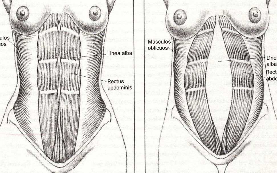 mujer embarazada con diastasis abdominal
