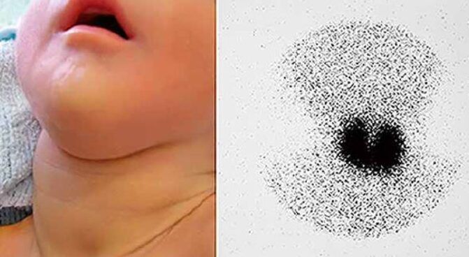 ninos con sintomas de tiroides