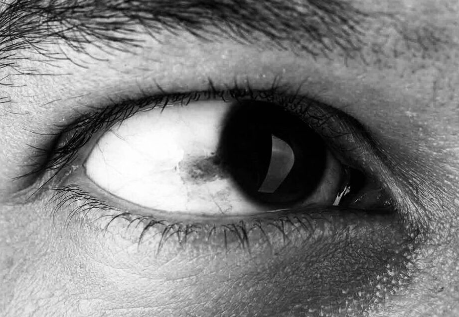 ojo con mancha negra