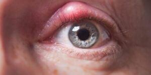 orzuelo en el ojo