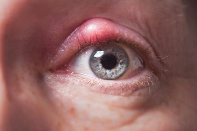 orzuelo en el ojo