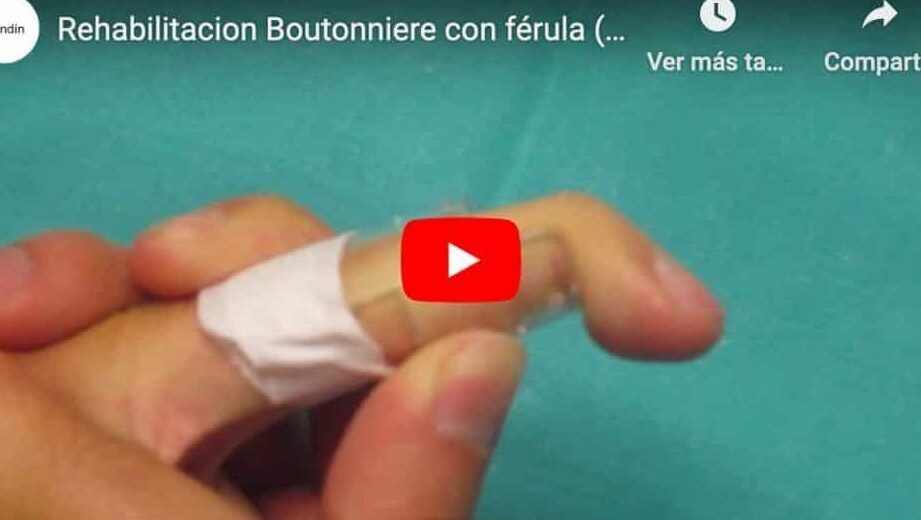 persona recibiendo un tratamiento para el dedo gordo torcido
