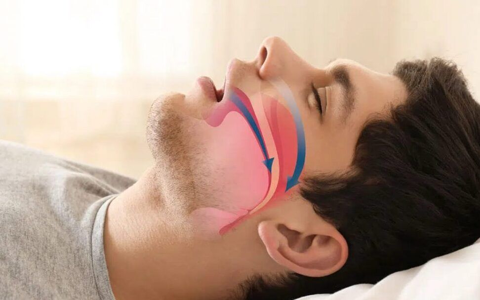 respiracion bucal y salud