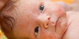 rostro enrojecido del bebe