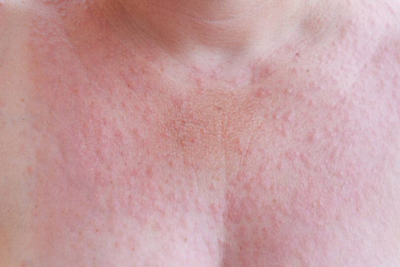 sintomas y alivio de la alergia al sol