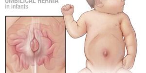tratamiento de hernias en bebes