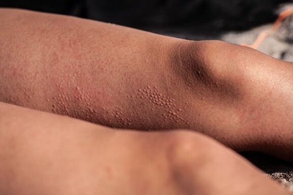 tratamiento de la alergia al calor