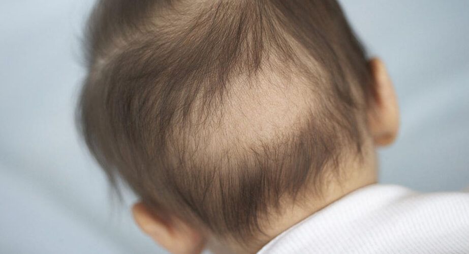 bebe perdiendo cabello