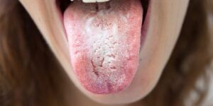 blanca lengua causas y tratamientos