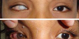 cambio seguro y natural de ojos