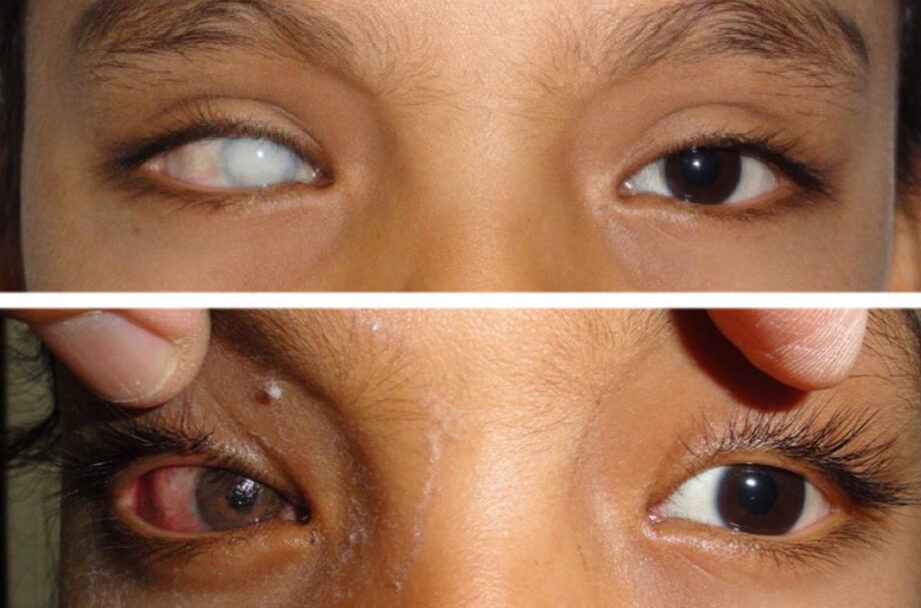 cambio seguro y natural de ojos