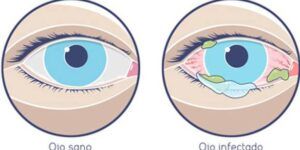 contagiosidad de la conjuntivitis