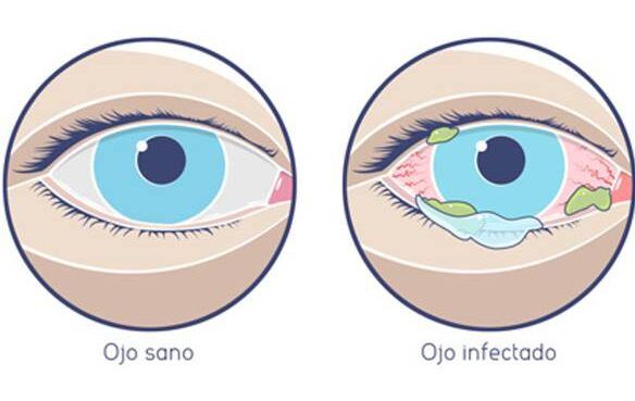 contagiosidad de la conjuntivitis