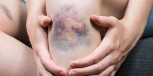 curacion de heridas en pierna